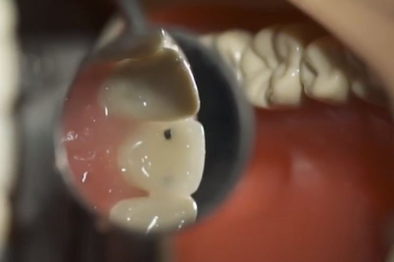 A closer look at our caries teeth